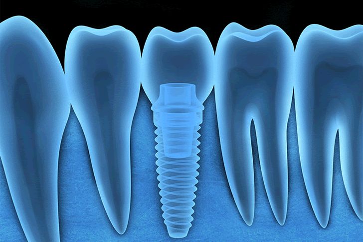 how long do dental implants last