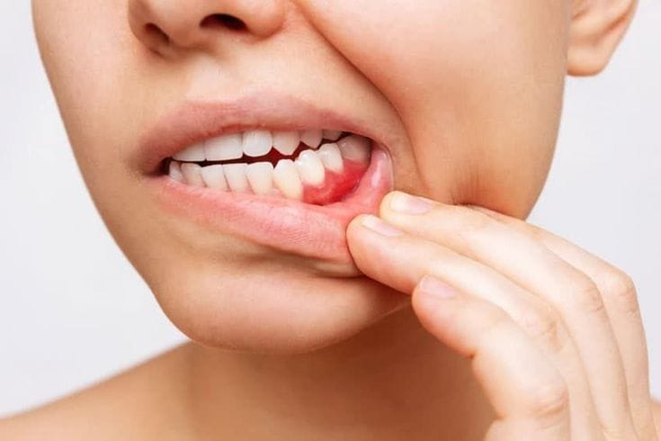 how long do dental implants last