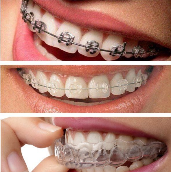 Teeth Braces: The Best Solution