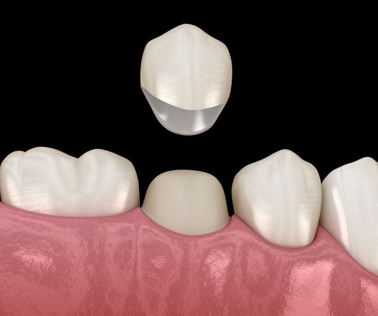 Dental Crowns and Bridges