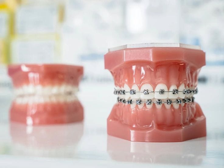 Teeth Braces: The Best Solution