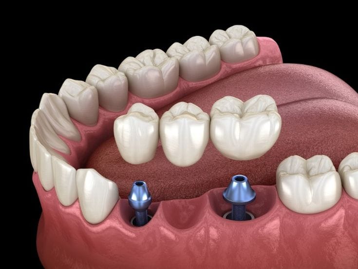 Dental Crowns and Bridges