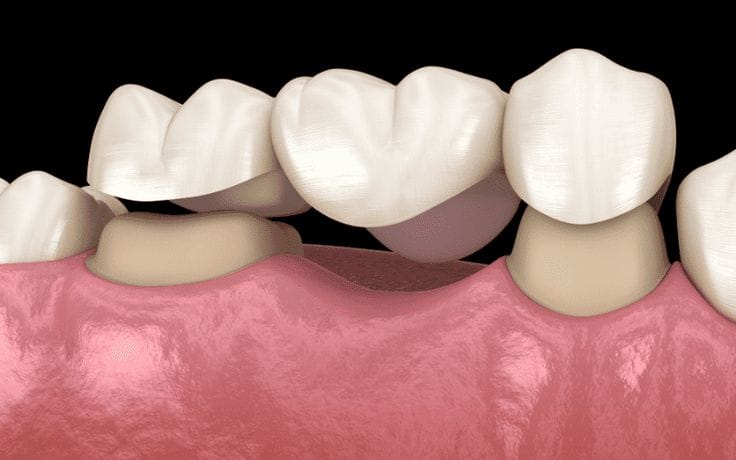 Dental Crowns and Bridges