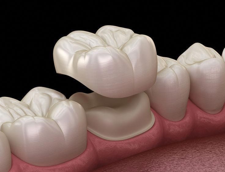 Dental Crowns and Bridges