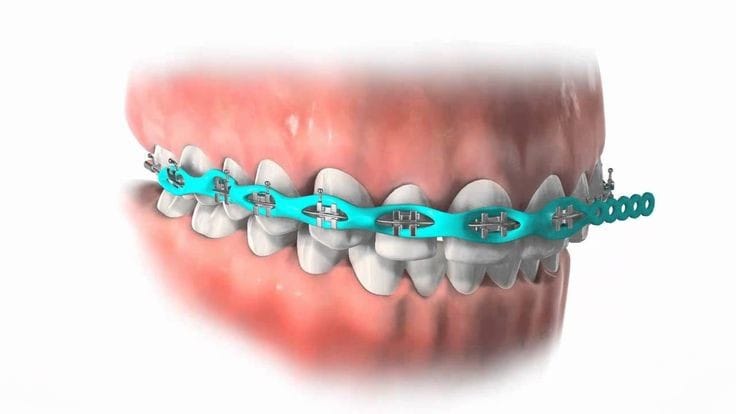 Teeth Braces: The Best Solution