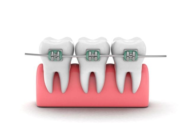 Teeth Braces: The Best Solution