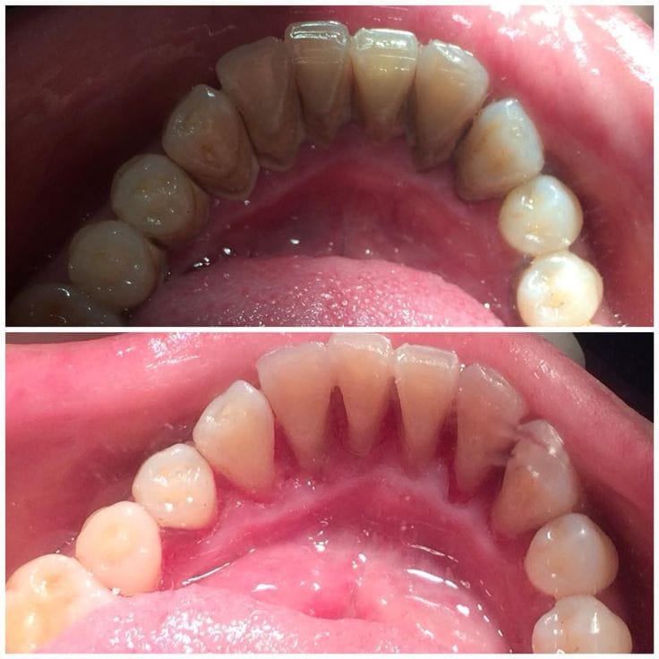 Oral Prophylaxis Procedure