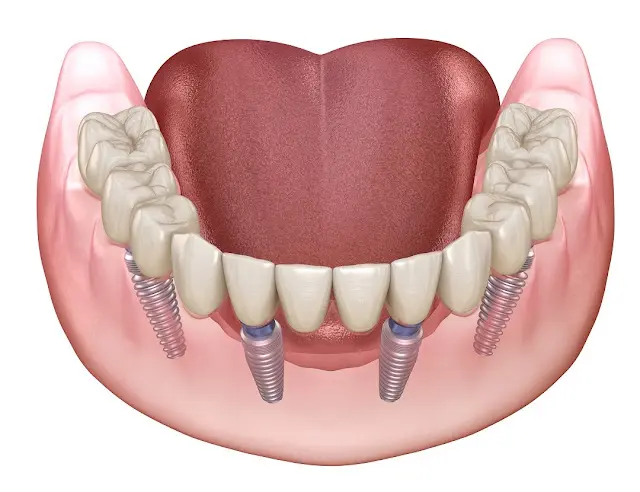Illustration of bite correction and jaw alignment