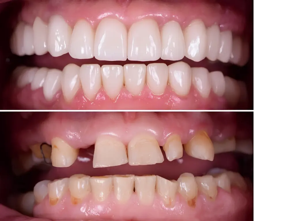 Complete Full Mouth Rehabilitation Transformation Result