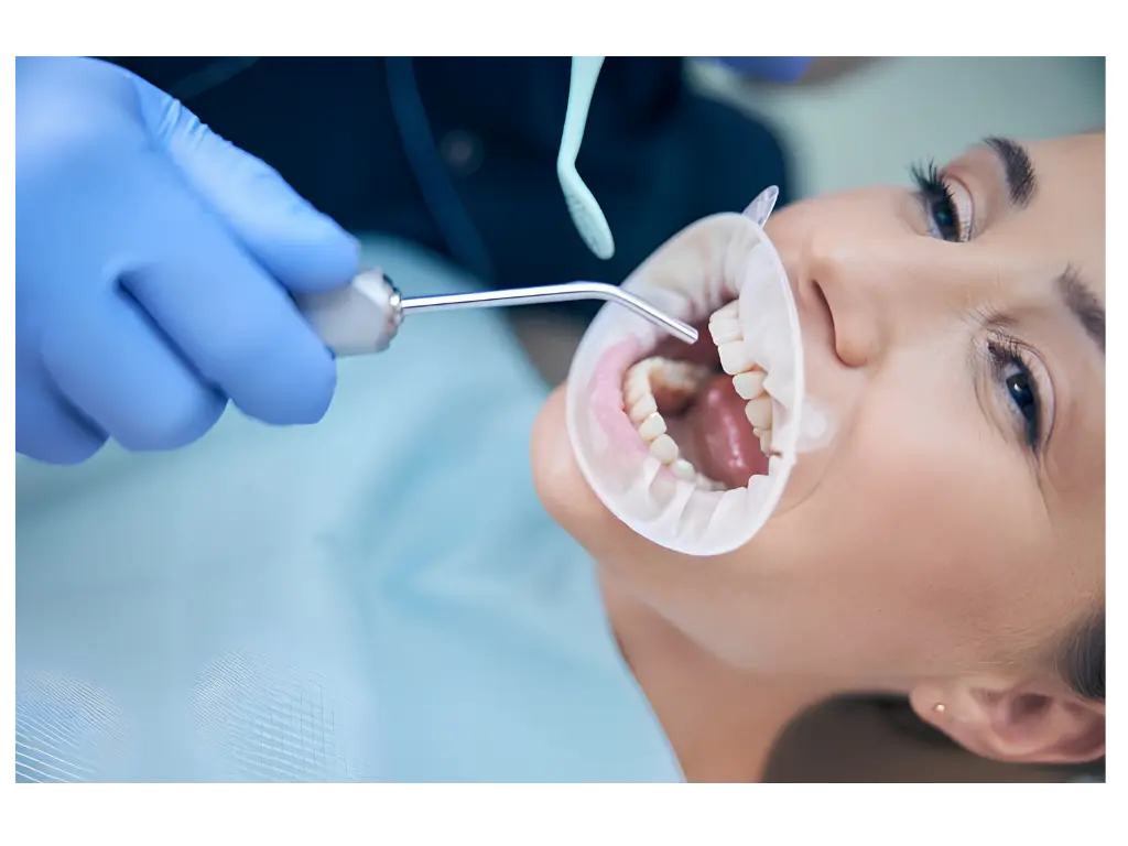 All-on-4 Full Arch Implant Bridge Illustration