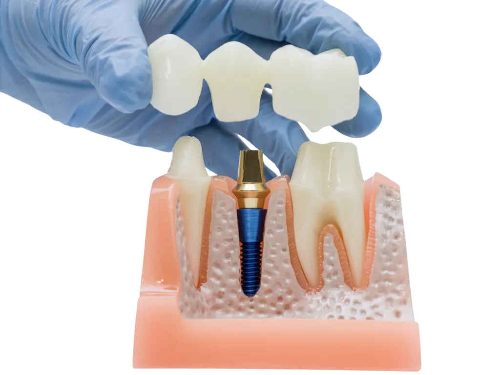 High Quality Dental Crown Illustration