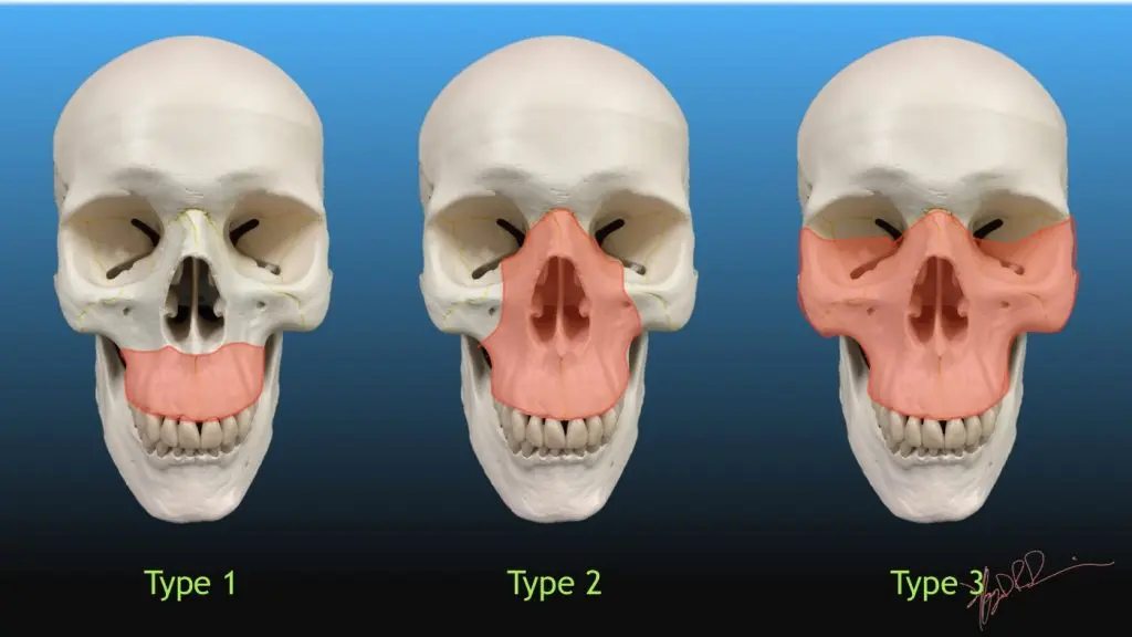 Facial Fracture and Trauma Treatment Hyderabad