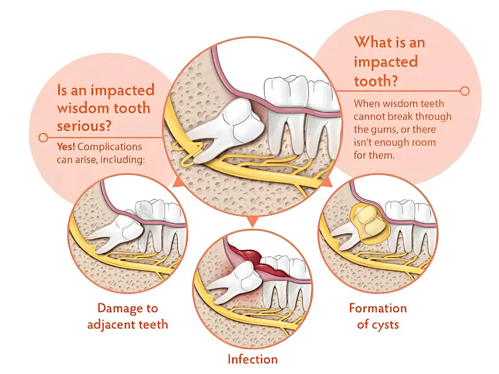 Clinical Surgical Extraction of Impacted Tooth