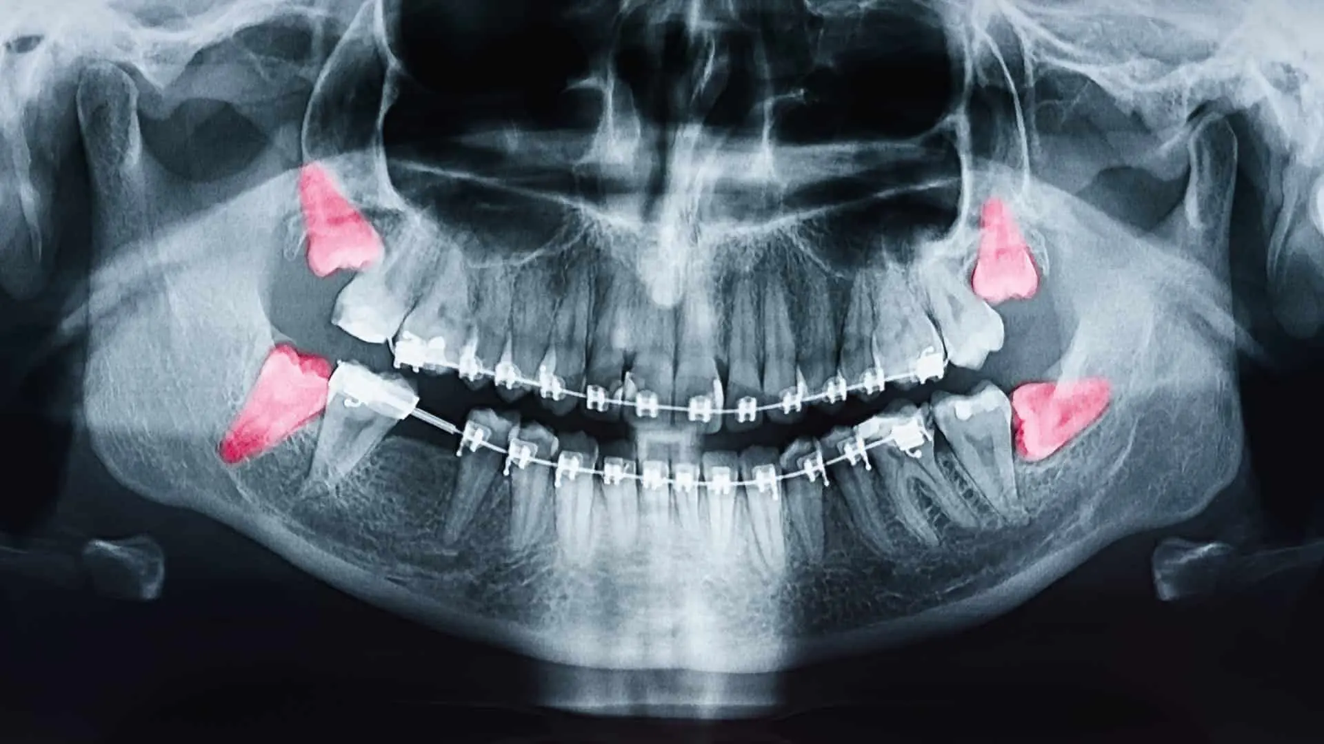 Different Types of Wisdom Tooth Impaction Clinical View