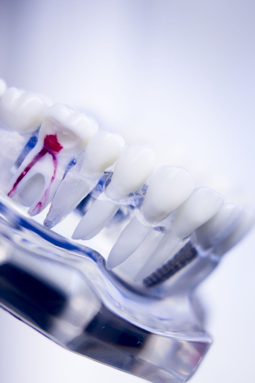 Expert Endodontic Root Canal Treatment