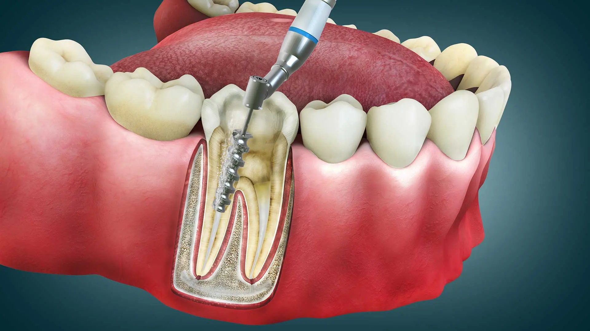 Painless Root Canal Treatment Hyderabad