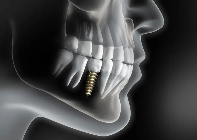 3D Guided Implant Surgery Planning