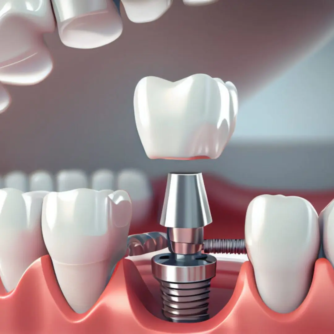 Permanent Dental Implants Hyderabad