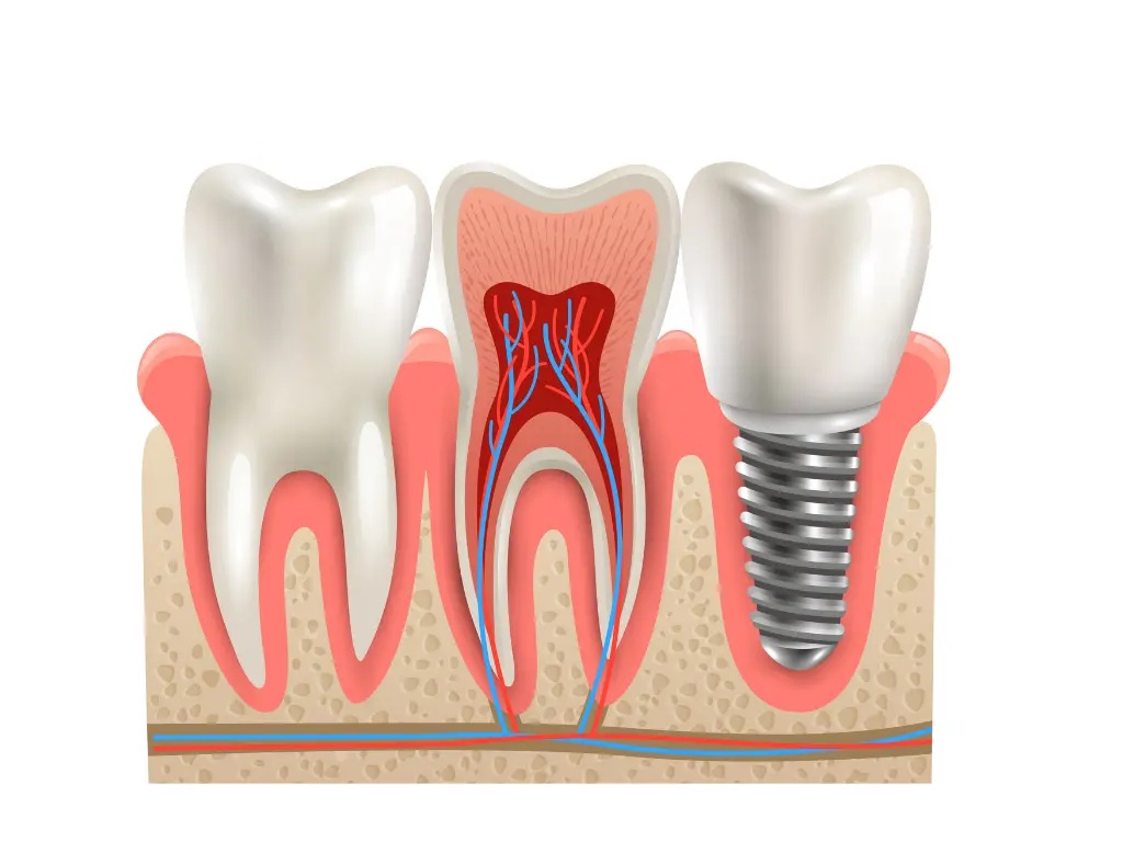 Anatomy of a Single Tooth Dental Implant