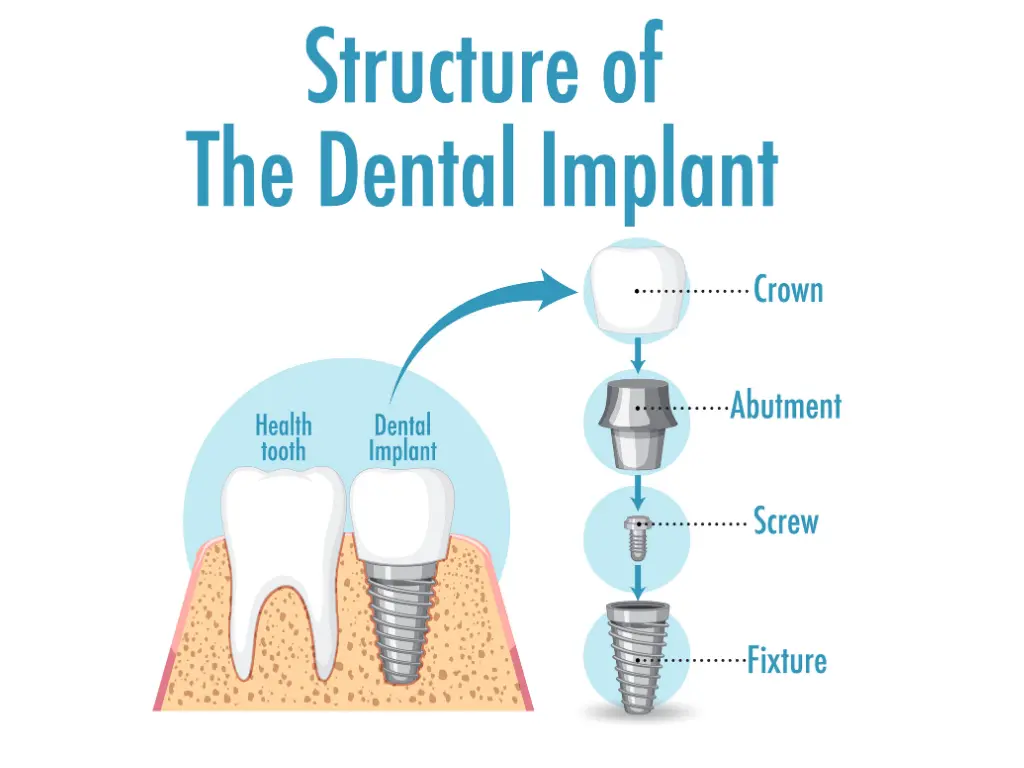 All-on-4 Dental Implant System Illustration
