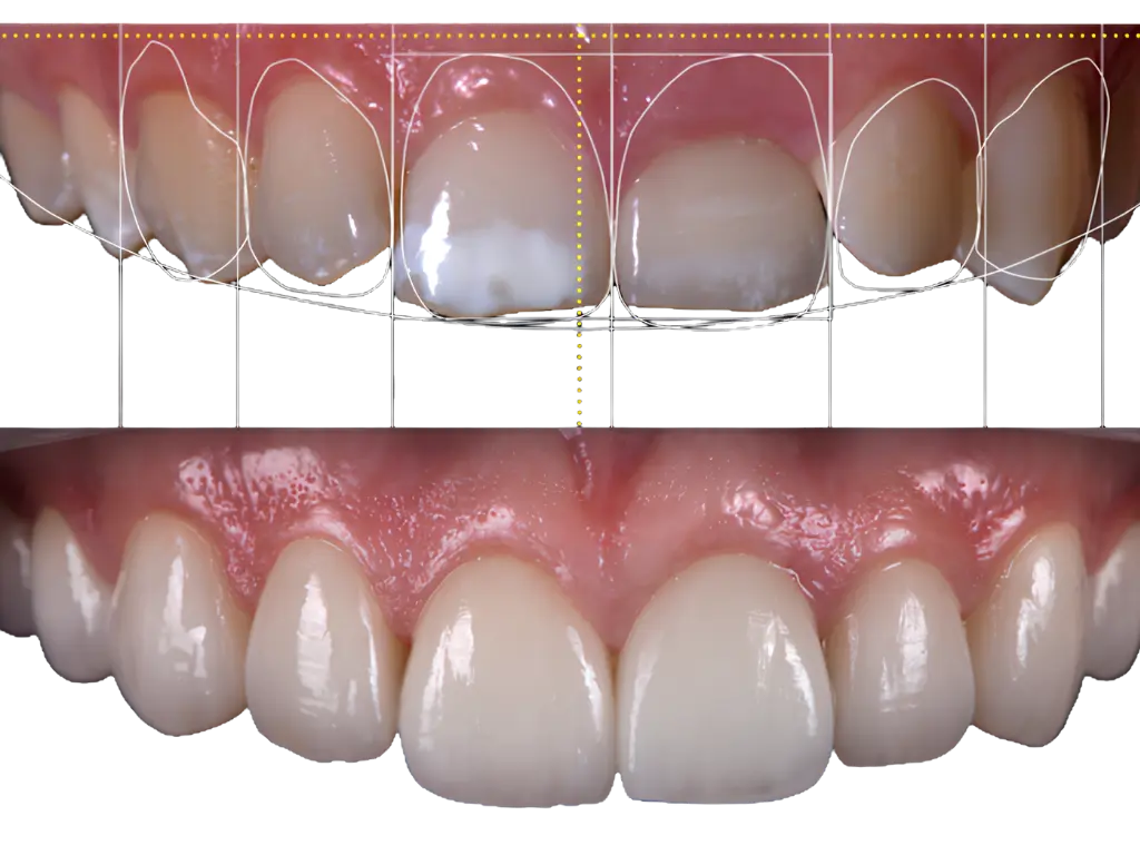 Dental Veneers Application Illustration